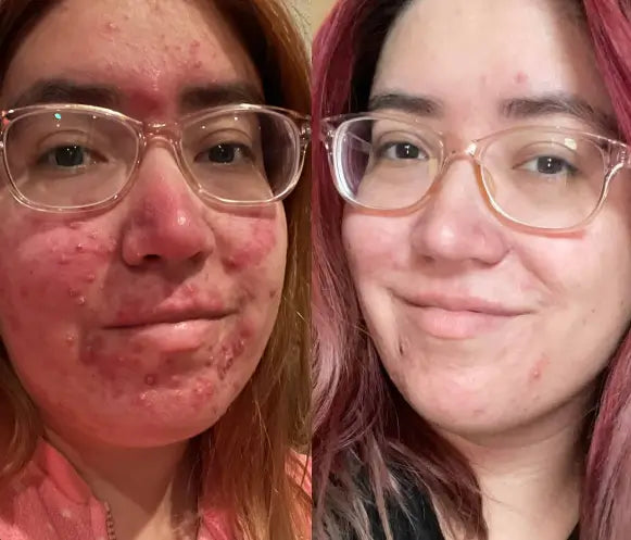 Clinically proven to remove 95% of moles, warts, and skin imperfections - permanently in just 3 days!