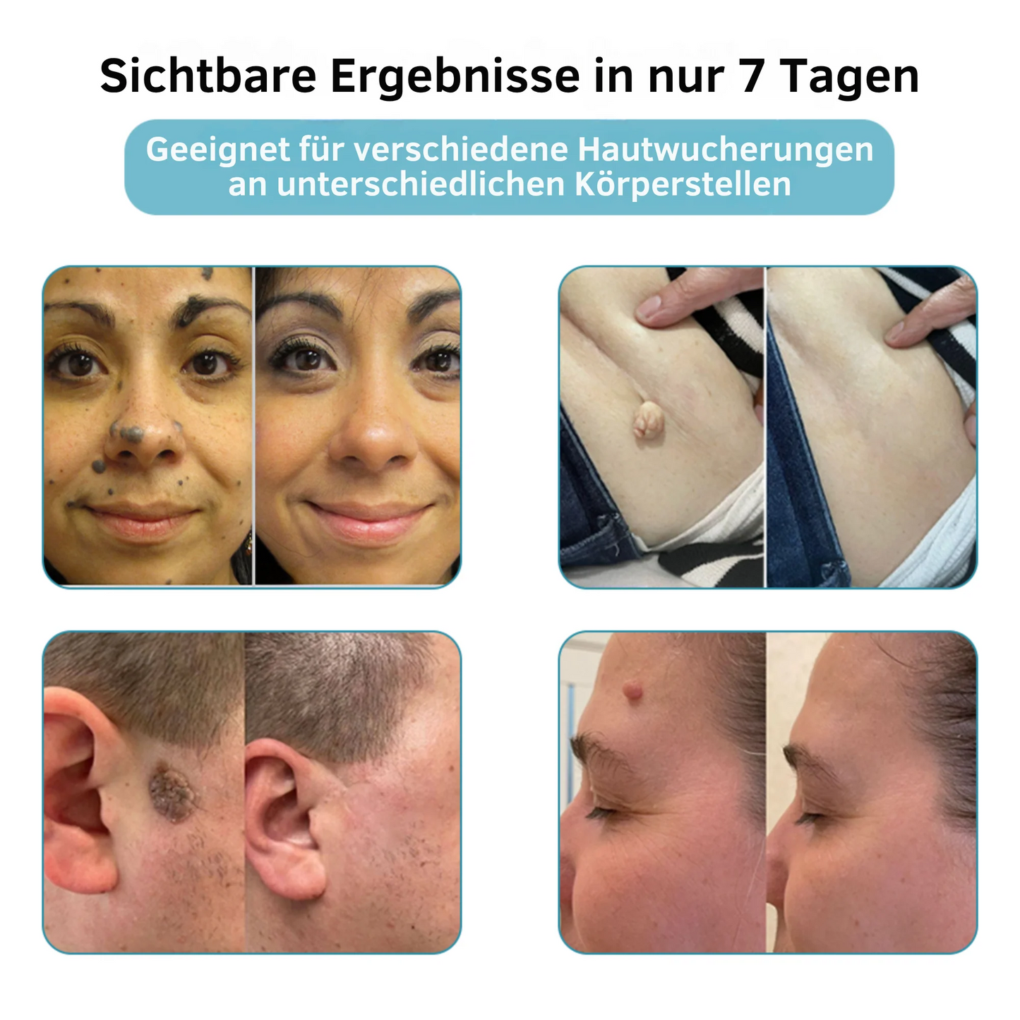 CO₂ Laser Pen for skin blemishes - removing warts & moles