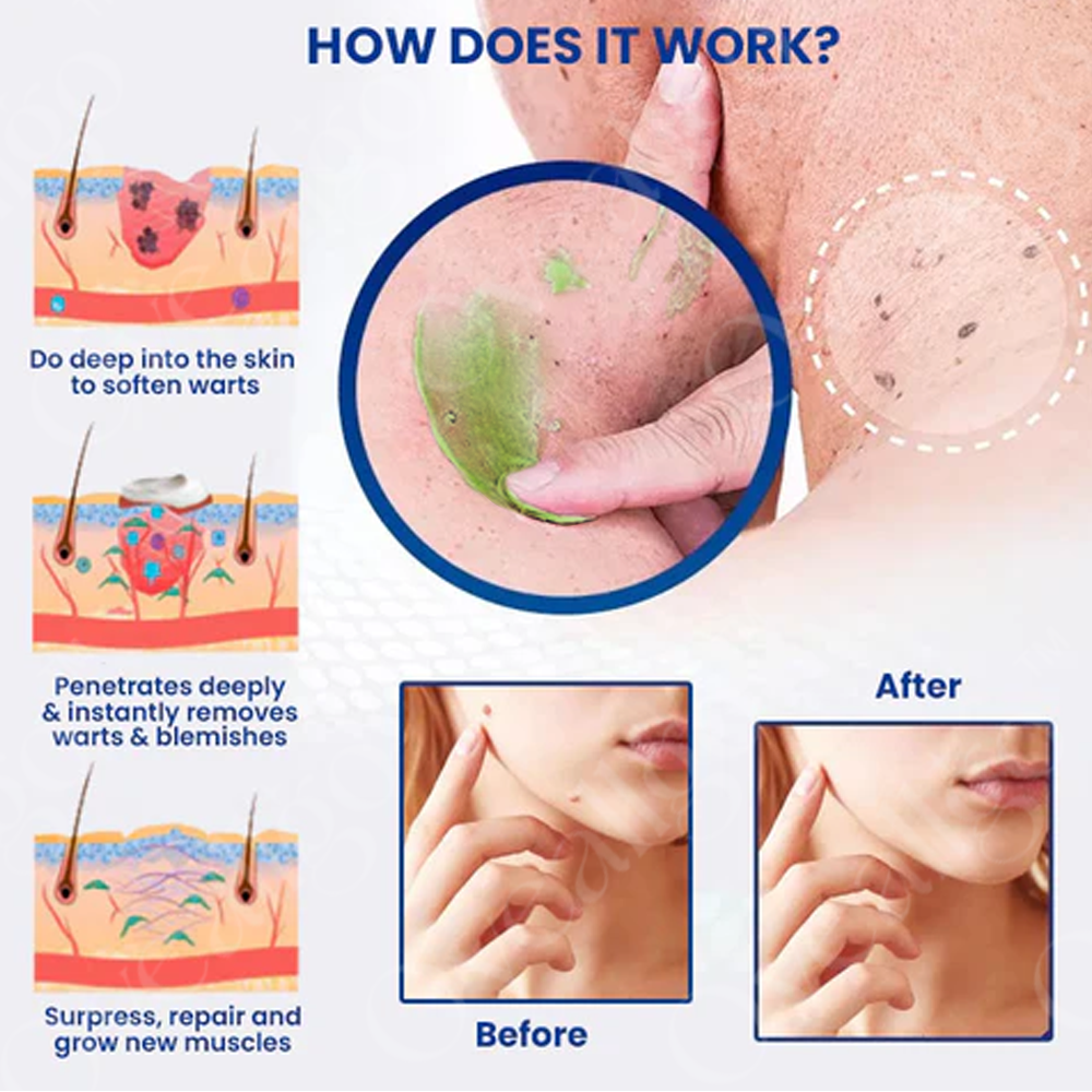 ✅ Official Store: Fivfivgo™ NatureErase Instant Mole & Spot Cream