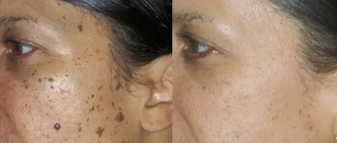 Clinically proven to remove 95% of moles, warts, and skin imperfections - permanently in just 3 days!