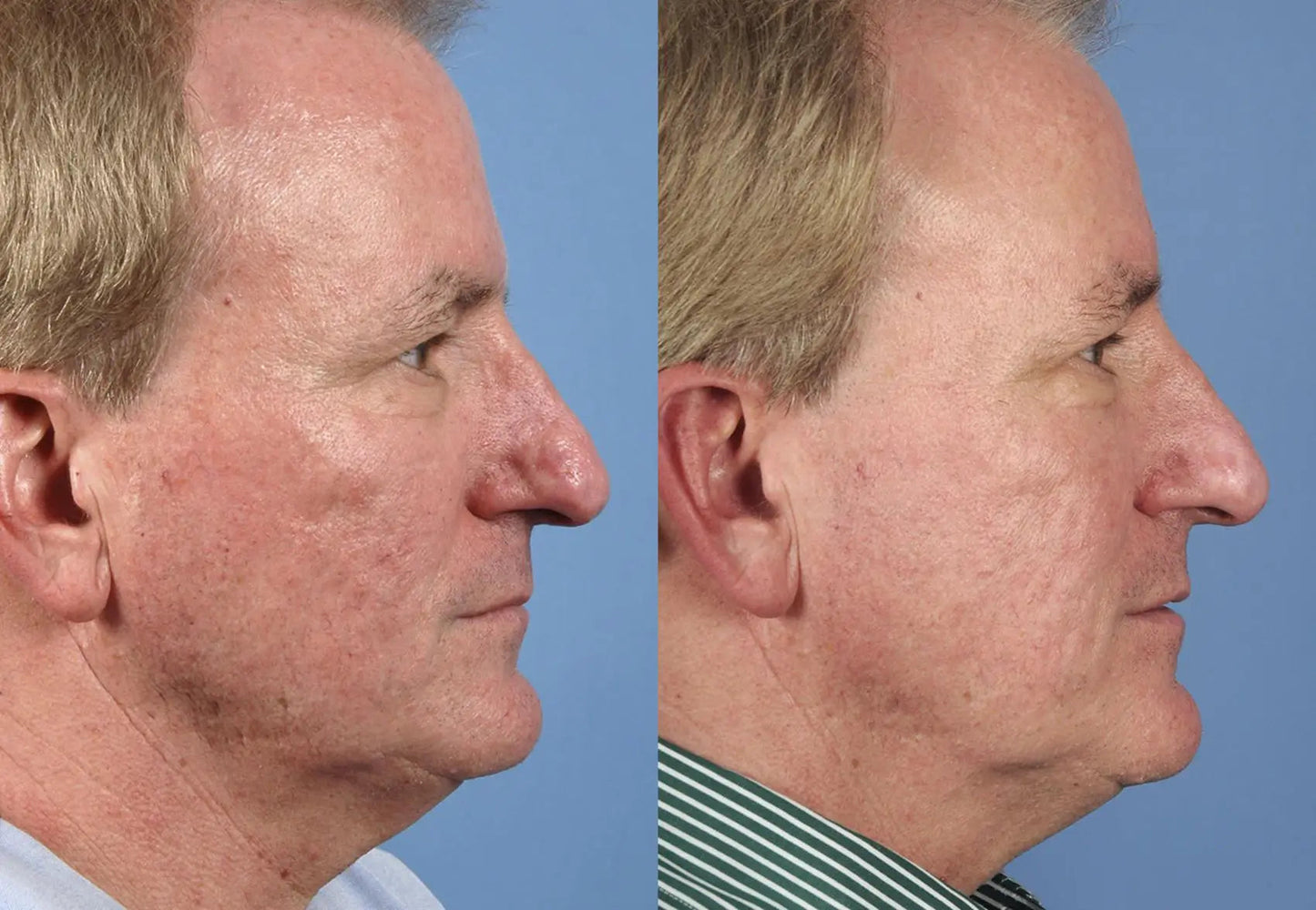 Clinically proven to remove 95% of moles, warts, and skin imperfections - permanently in just 3 days!