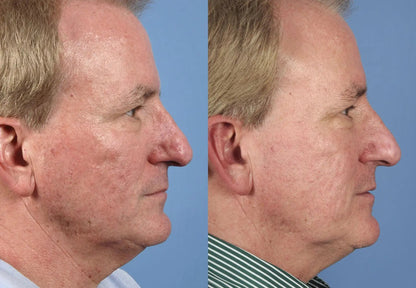 Clinically proven to remove 95% of moles, warts, and skin imperfections - permanently in just 3 days!