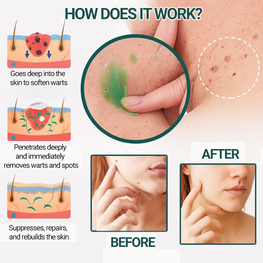 Clinically proven to remove 95% of moles, warts, and skin imperfections - permanently in just 3 days!