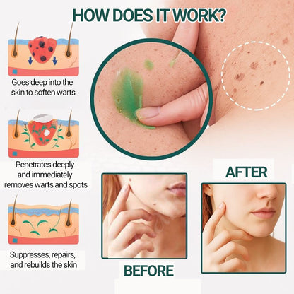 Clinically proven to remove 95% of moles, warts, and skin imperfections - permanently in just 3 days!