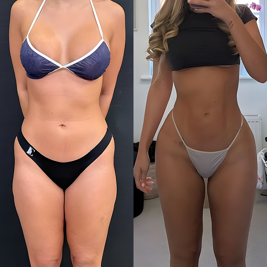 Micro-Needle Firming Patches: Reverse the Flattening Caused by Sitting For Visibly Firmer, Lifted Curves In 4 Weeks, No Surgery