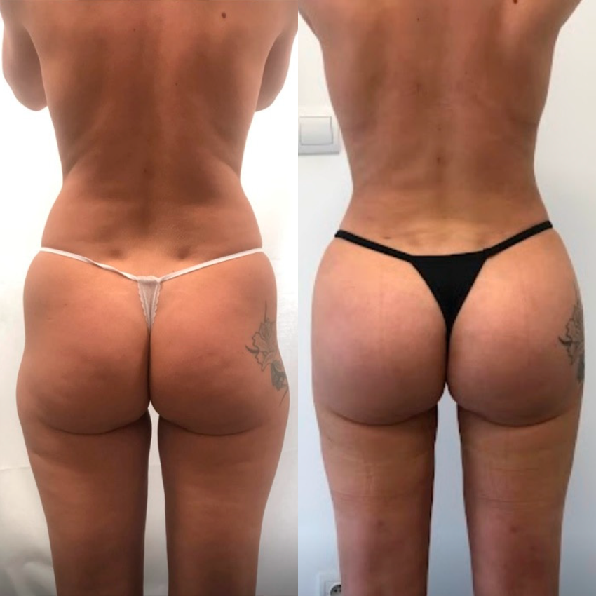 Micro-Needle Firming Patches: Reverse the Flattening Caused by Sitting For Visibly Firmer, Lifted Curves In 4 Weeks, No Surgery