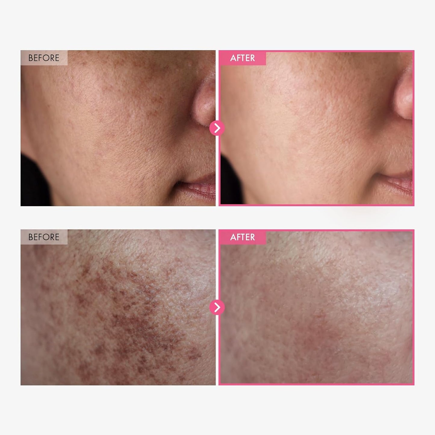 Korean Advanced Arbutin Brightening Cream Erase dark spots and uneven skin tone in 2 weeks
