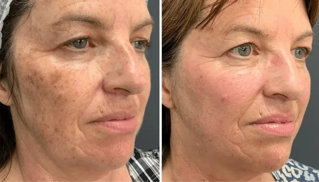 Clinically proven to remove 95% of moles, warts, and skin imperfections - permanently in just 3 days!