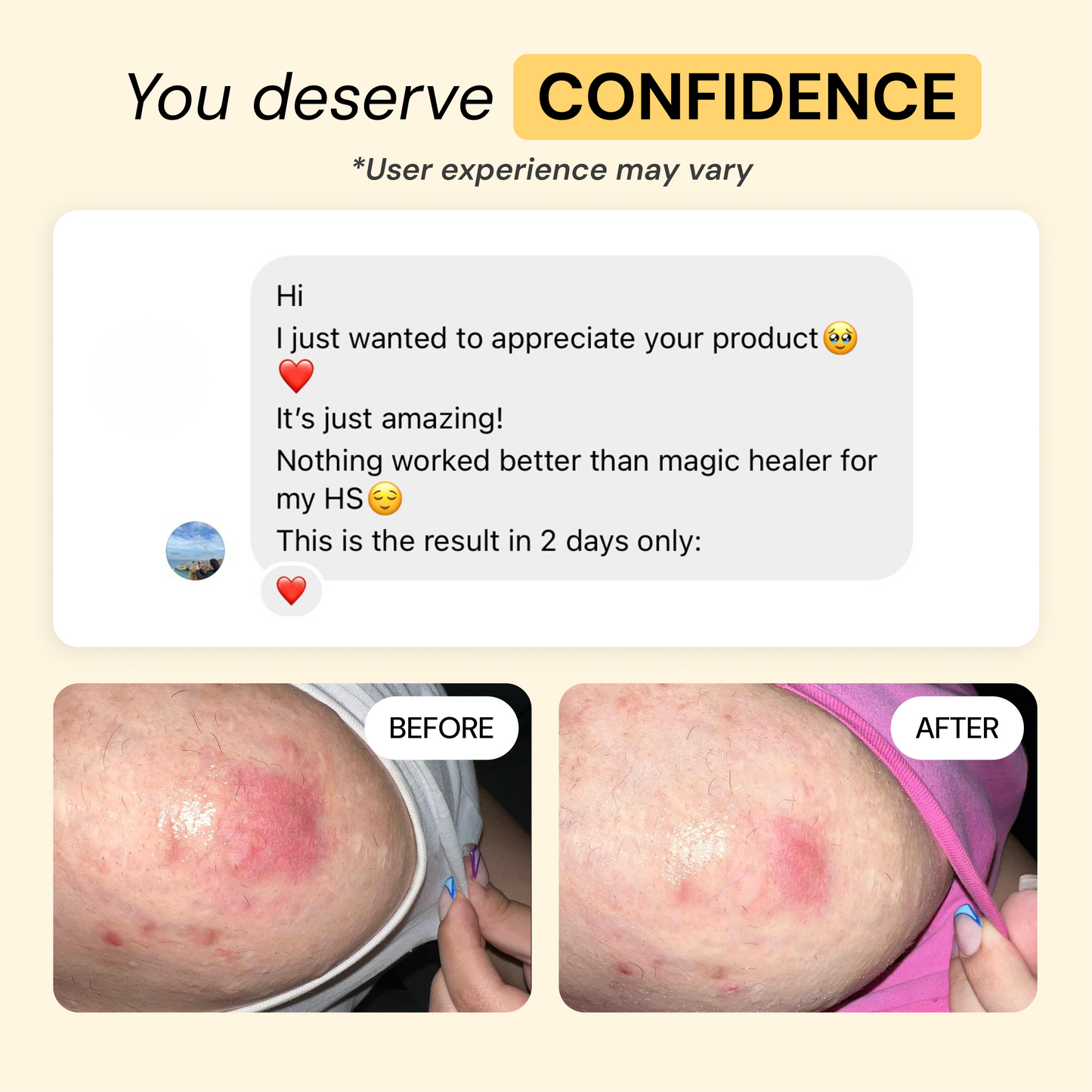 Universal Flare Care Calmer Skin in 7 Days for Boils, HS, Cysts & Painful Flare-Ups