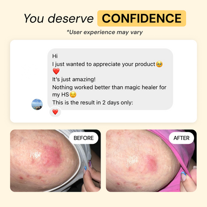 Universal Flare Care Calmer Skin in 7 Days for Boils, HS, Cysts & Painful Flare-Ups