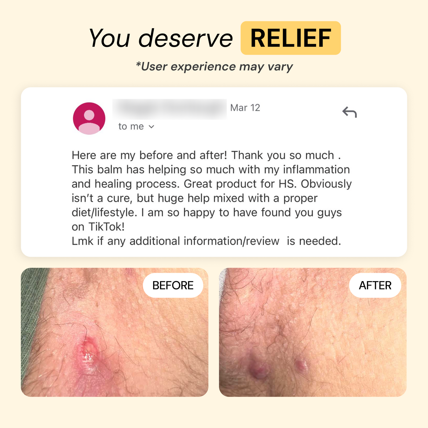 Universal Flare Care Calmer Skin in 7 Days for Boils, HS, Cysts & Painful Flare-Ups