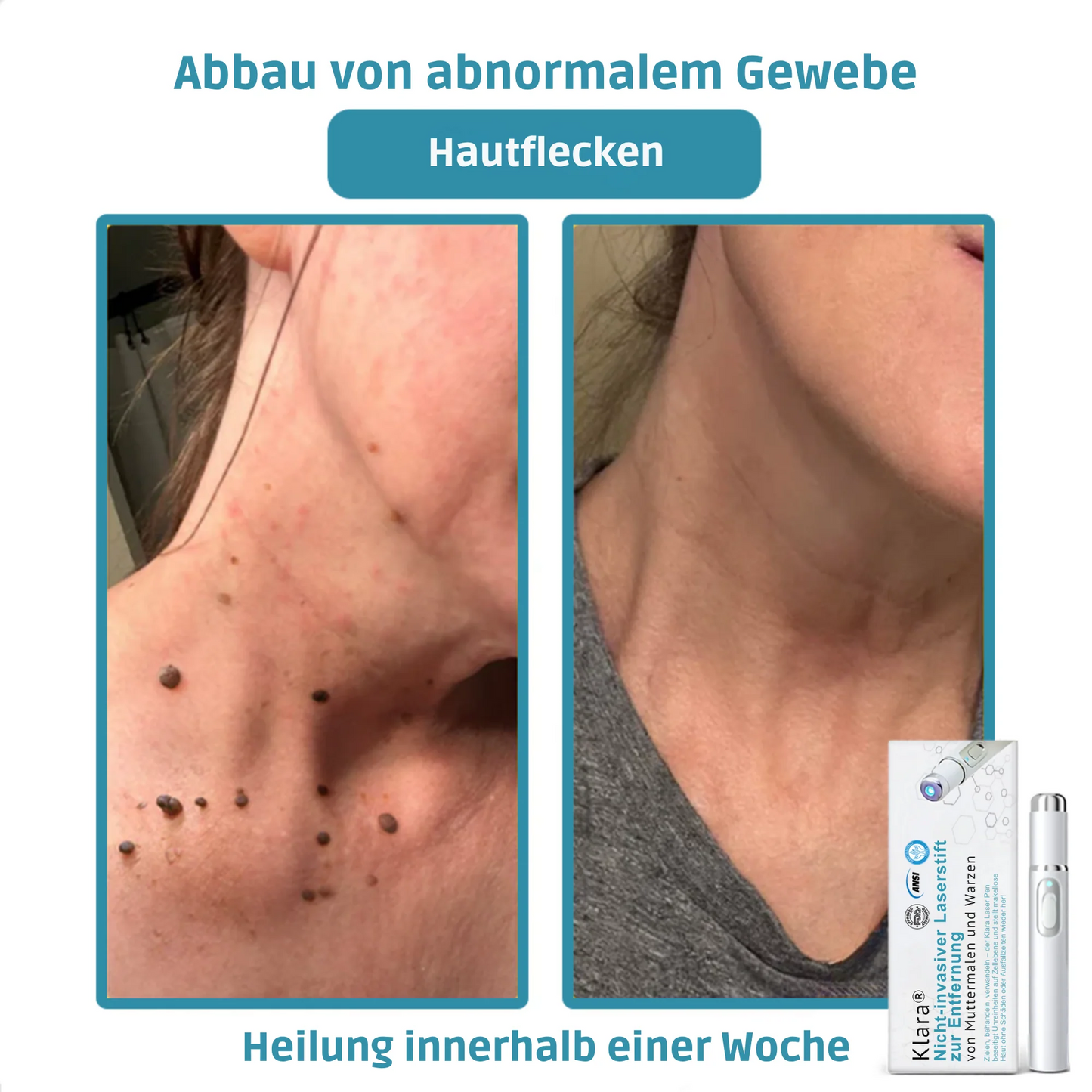 CO₂ Laser Pen for skin blemishes - removing warts & moles