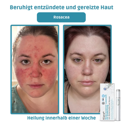 CO₂ Laser Pen for skin blemishes - removing warts & moles