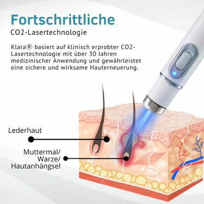 CO₂ Laser Pen for skin blemishes - removing warts & moles