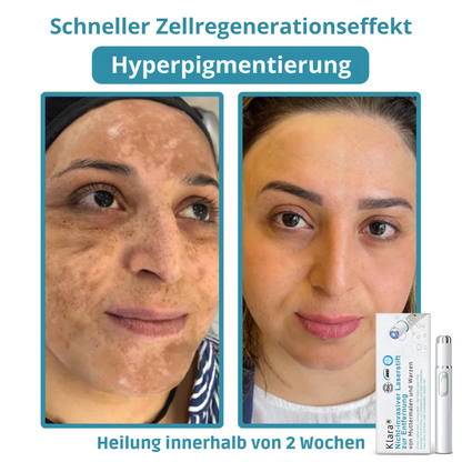 CO₂ Laser Pen for skin blemishes - removing warts & moles