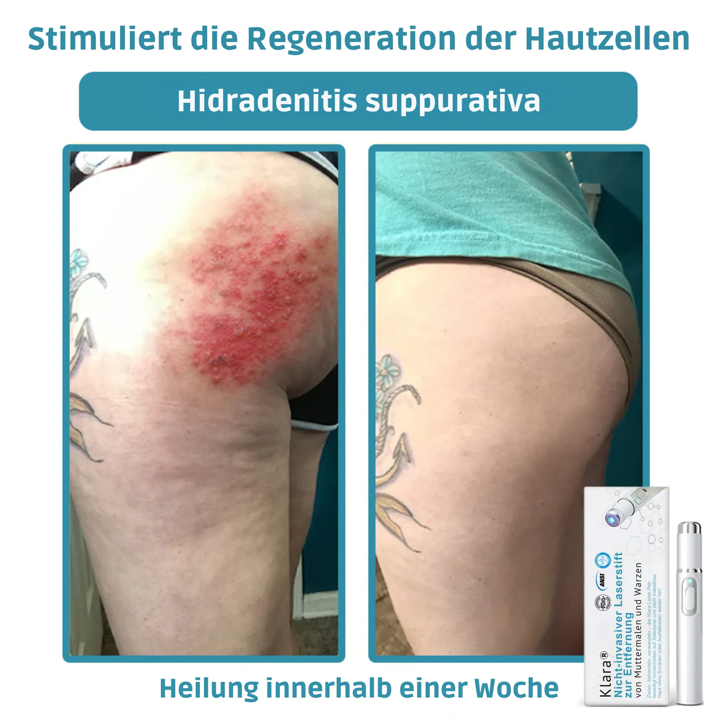 CO₂ Laser Pen for skin blemishes - removing warts & moles