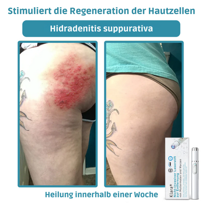 CO₂ Laser Pen for skin blemishes - removing warts & moles