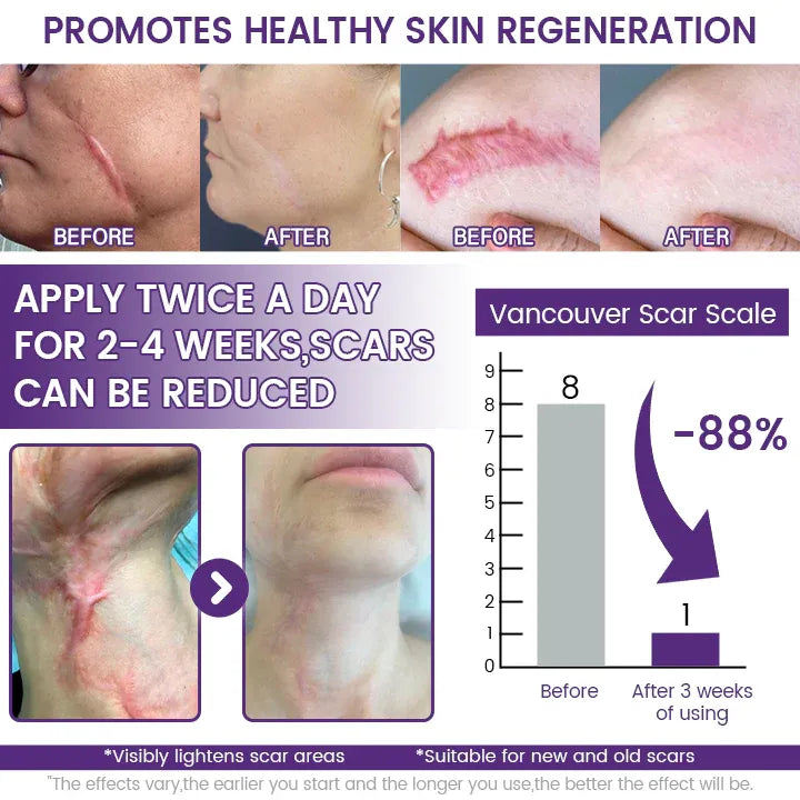Timilk® ReGenScar Stem Cell Scar Gel - Advanced Skin Repair Formula for Acne, Stretch Marks & Surgical Scars | Fast Healing & Smooth Skin Care