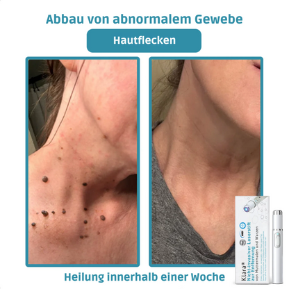 CO₂ Laser Pen for skin blemishes - removing warts & moles