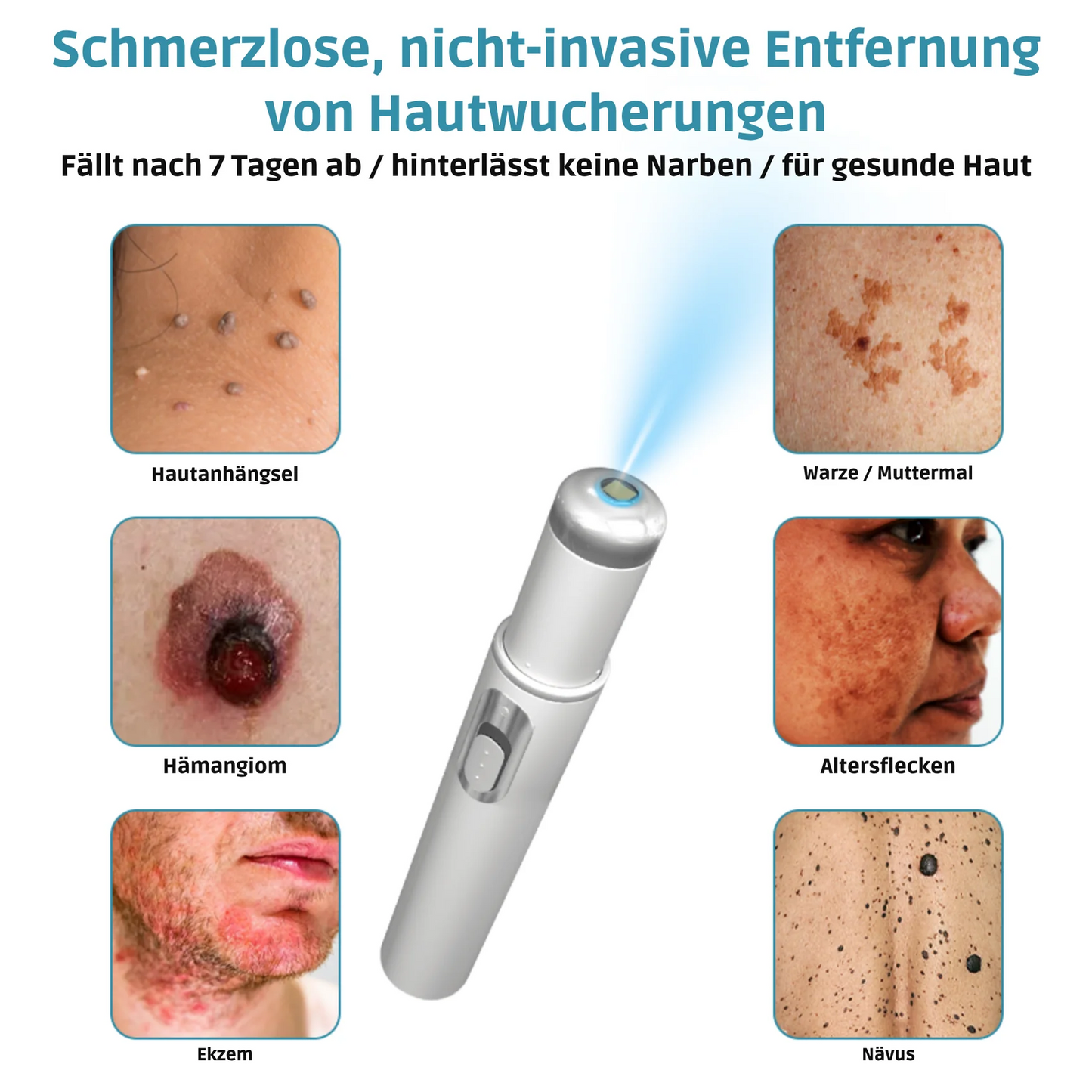 CO₂ Laser Pen for skin blemishes - removing warts & moles