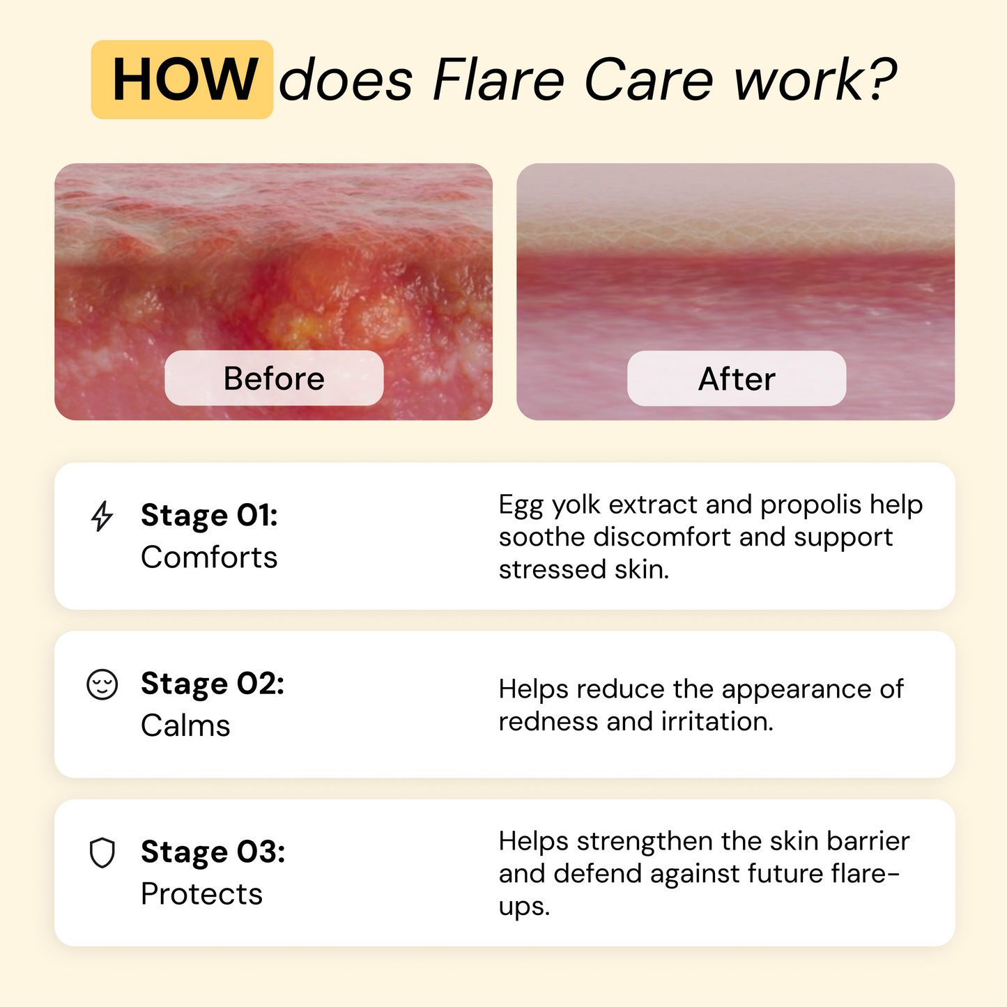 Universal Flare Care Calmer Skin in 7 Days for Boils, HS, Cysts & Painful Flare-Ups