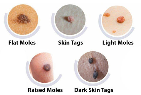 ✅ Official Store: Fivfivgo™ NatureErase Instant Mole & Spot Cream