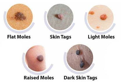 ✅ Official Store: Fivfivgo™ NatureErase Instant Mole & Spot Cream